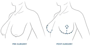 Breast lift incision patterns used in a mommy makeover in Turkey