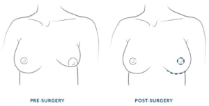 Breast augmentation included in a mommy makeover surgery in Turkey