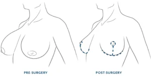Breast reduction procedure within a mommy makeover treatment plan in Turkey