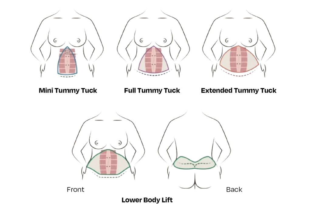 tummy tuck surgery in turkey