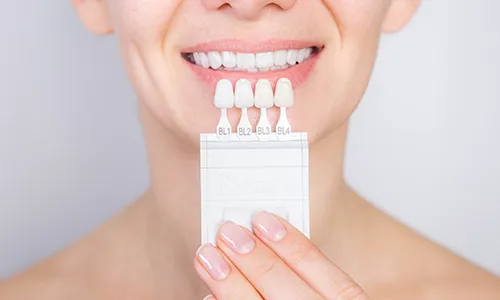 Tooth whitening,-500300 copy