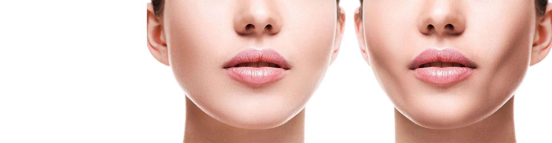 Buccal Fat Removal