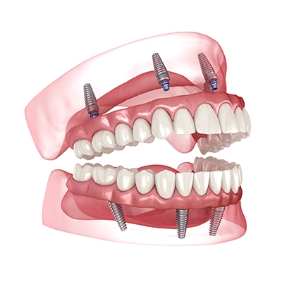 dent4-400x400