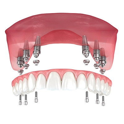 dent6-400x400