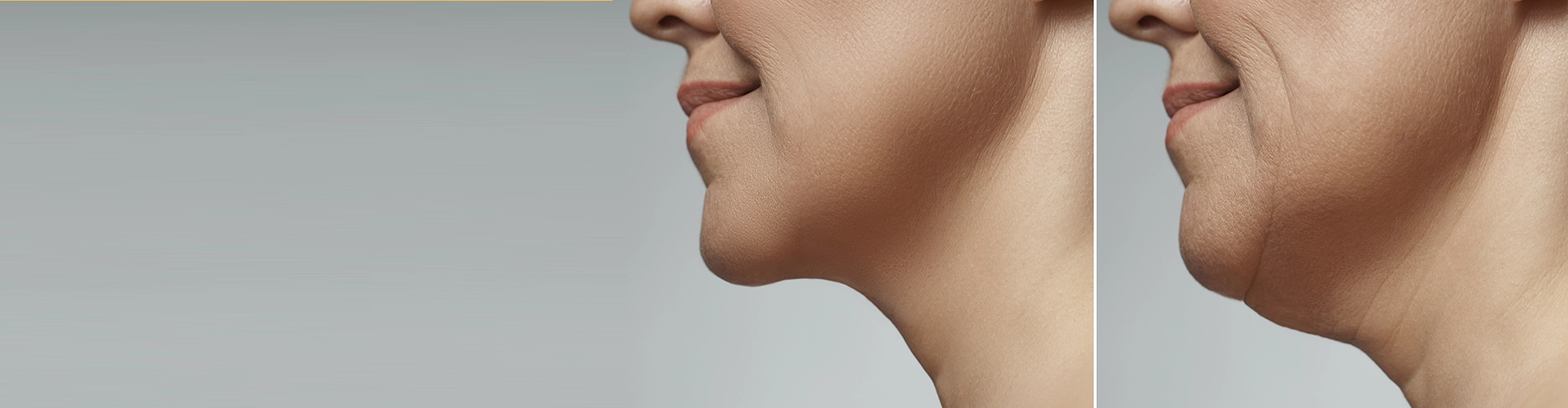 Gıdı Liposuction