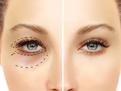 upper eyelid-500*300