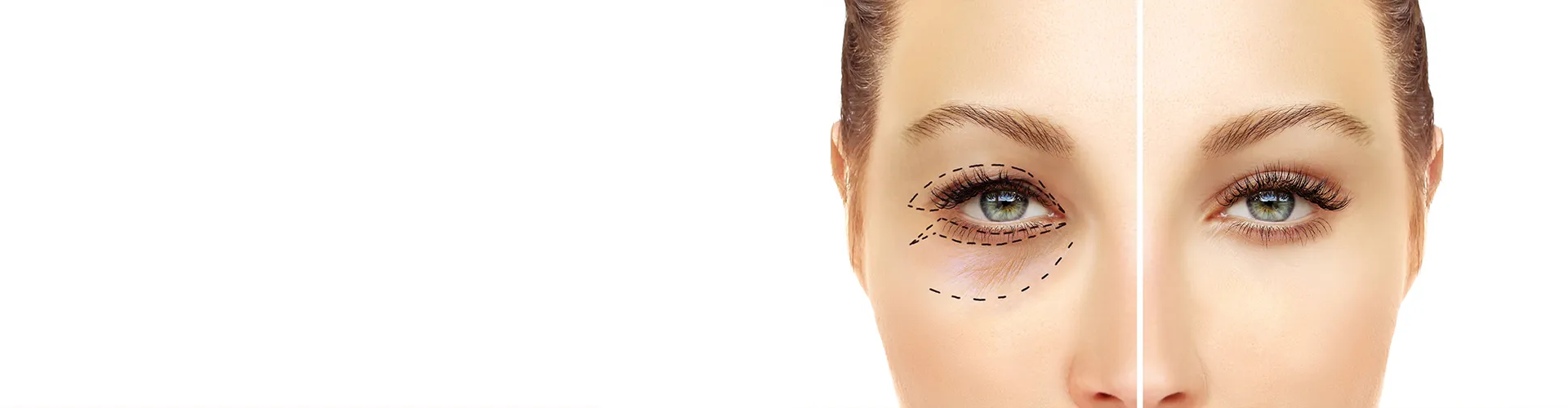 Blepharoplastik