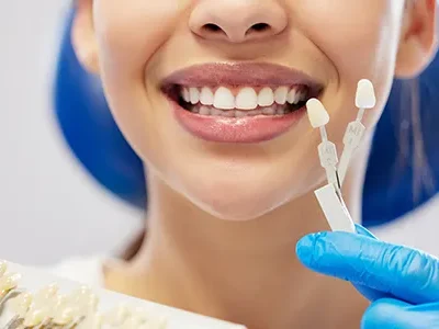 Prepless Veneers-2-500x300