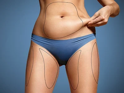 ultrasound-assisted liposuction-500300 copy