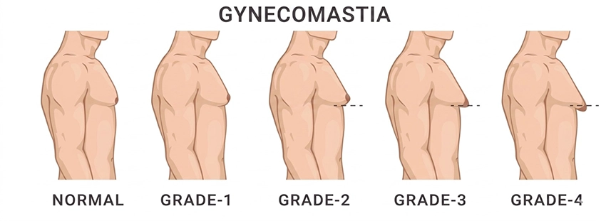 Gynecomastia grade illustration